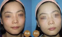 徒手祛斑爆料视频教程下载